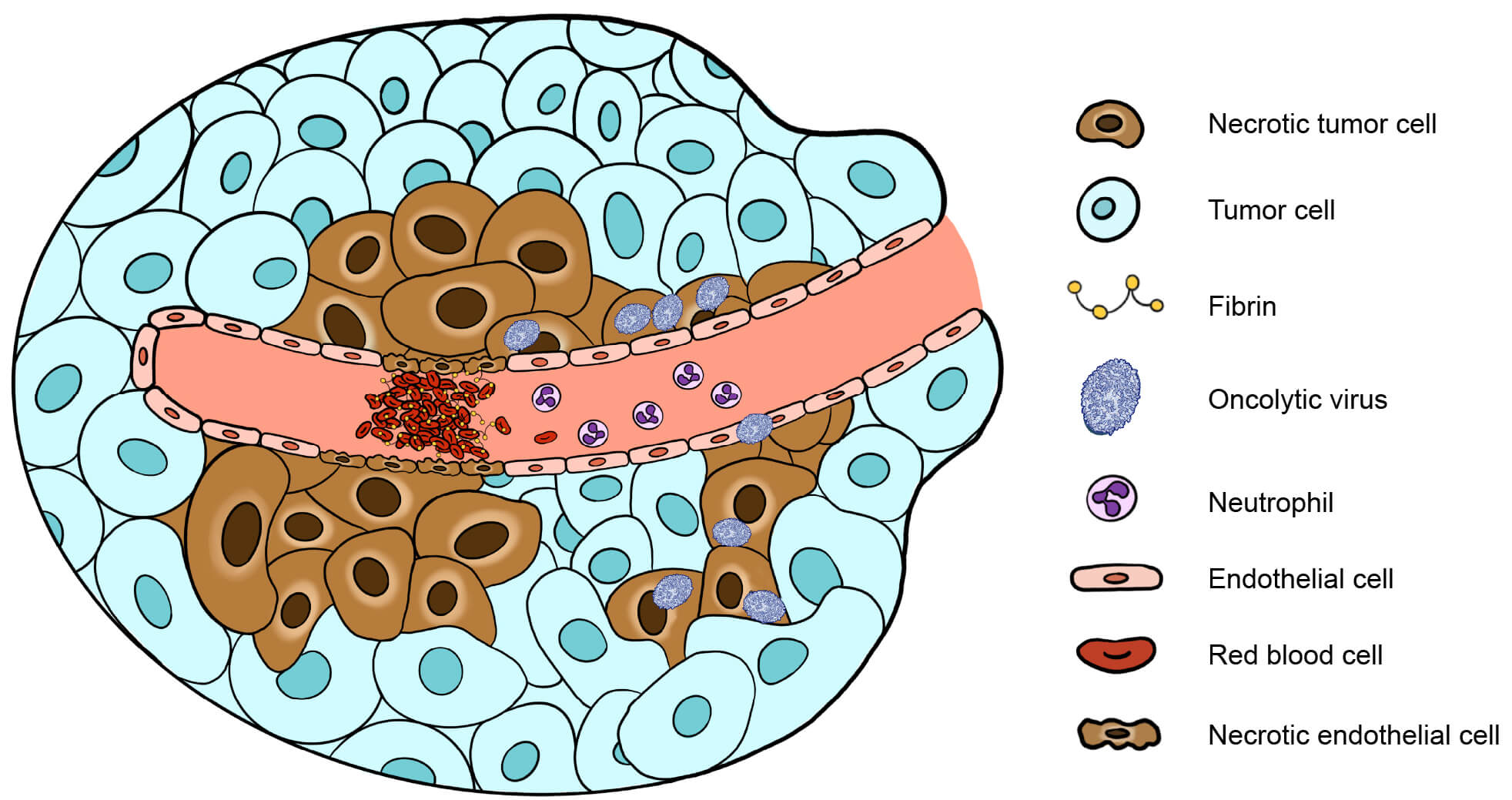 blood_vessel_with_neutrophilsvirus_and_blot_clot_formation_causing_damage_to_tumor